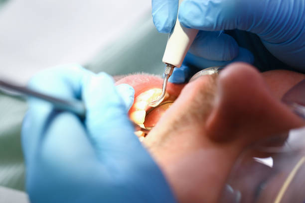 Best Emergency Treatment for Dental Infections or Abscesses in Starbuck, MN